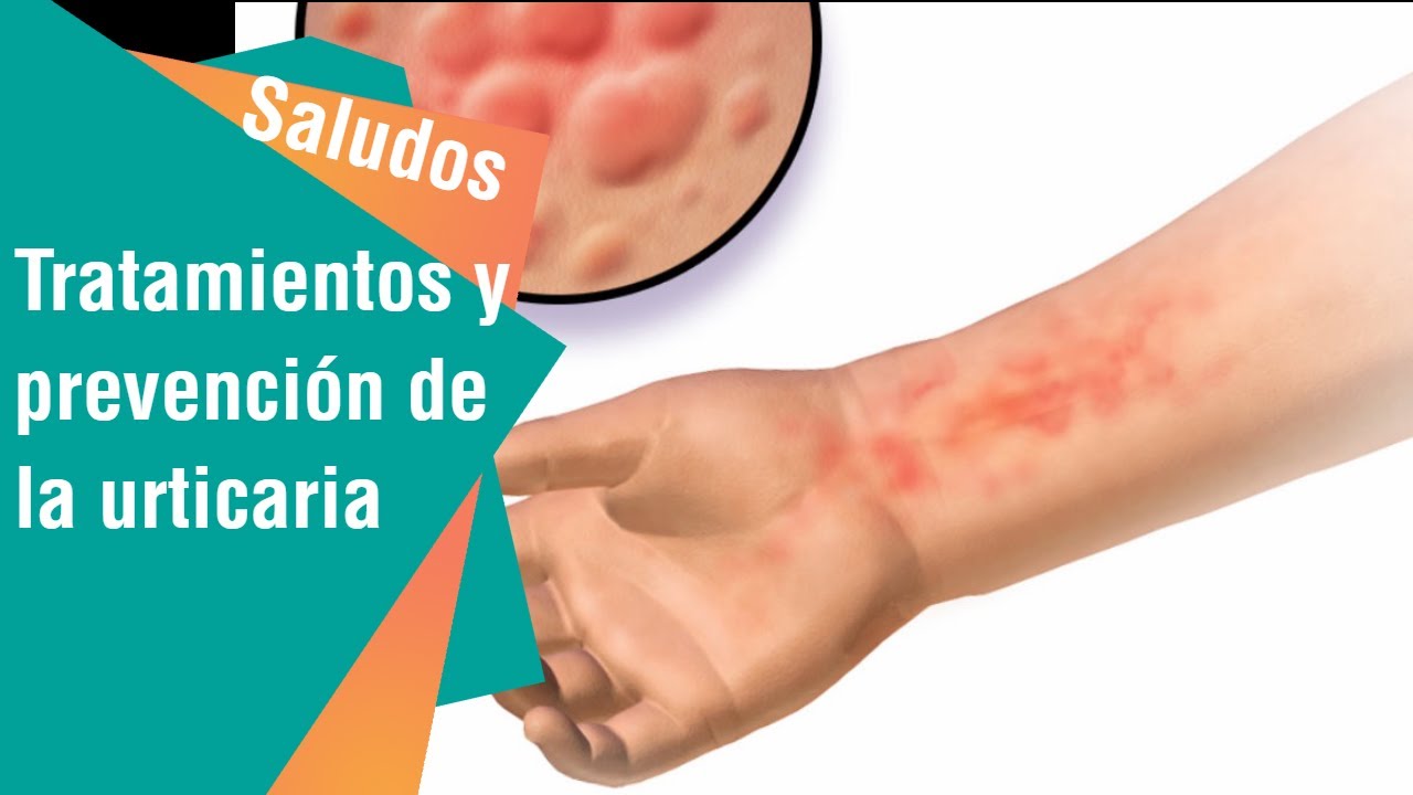  C mo Prevenir La Urticaria Y Cu les Son Sus Tratamientos Saludos 