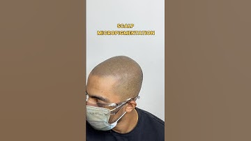 3 sessions of scalp micropigmentation density build up #scalpmicropigmentation #smp