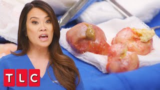 Patient's Scalp is Covered in Pilar Cysts! | Dr. Pimple Popper