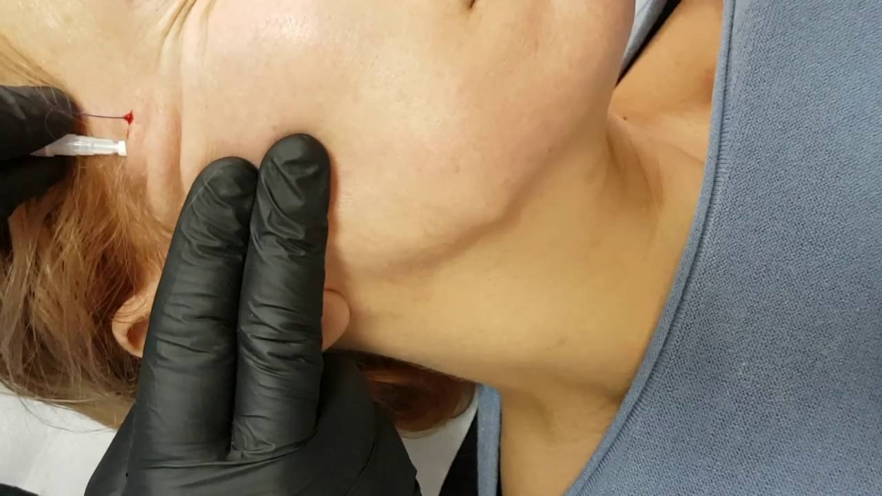 Nici liftingujące Barb 4D haczyki