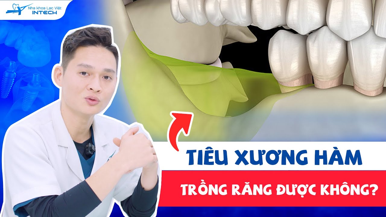 Outline Video Tiêu Xương Hàm Có Trồng Răng Được Không? Giải Pháp Nào Khi Bị Tiêu Xương Hàm?