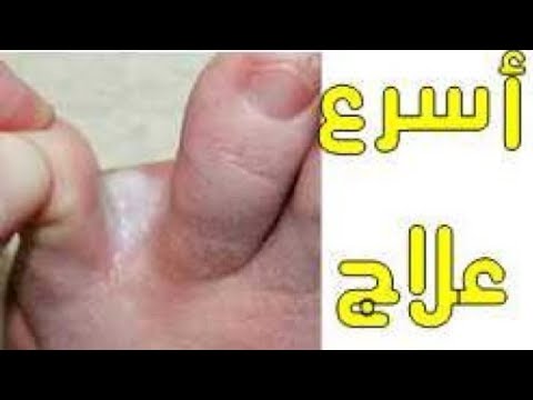 فيديو: بين أصابع القدم حكة؟