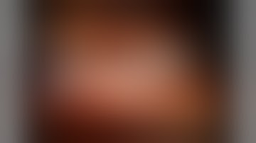 Obstructed retrocaval ureter in a solitary functioning kidney