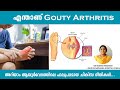  gouty arthritis  dr roshni ayur talks  ayurveda  malayalam