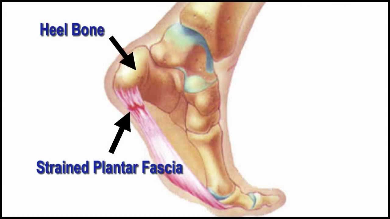 Heel Pain After Running: Causes, Treatment, Prevention