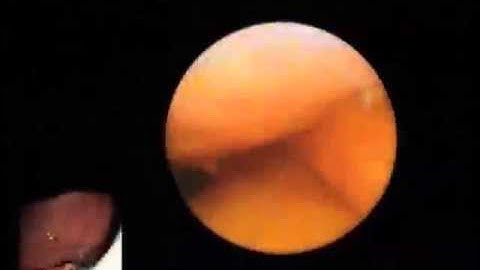 Cholangioscopy for Diagnosing PSC, Douglas Adler, MD, Univ of Utah, Salt Lake City, Utah