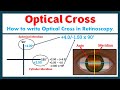 Optical cross in retinoscopy retinoscopy refraction eye optometry