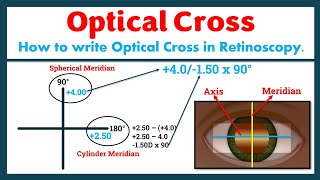 Optical Cross in Retinoscopy (#retinoscopy #refraction #eye #optometry)