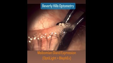 Meibomian Gland Expression (OptiLight + BlephEx) #dryeyejuly #dryeye #mgd #optilight #ipl #blephex