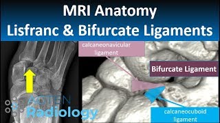 Lisfranc and Bifurcate Ligaments: MRI Anatomy