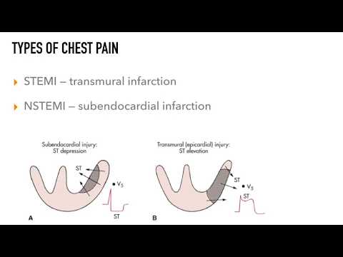 Video: Types Of Myocardial Infarction: Classification, Atypical And Abdominal Forms