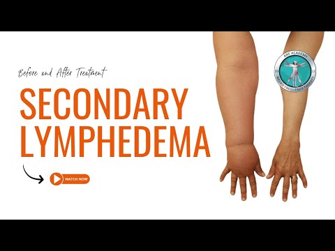 Secondary Lymphedema :