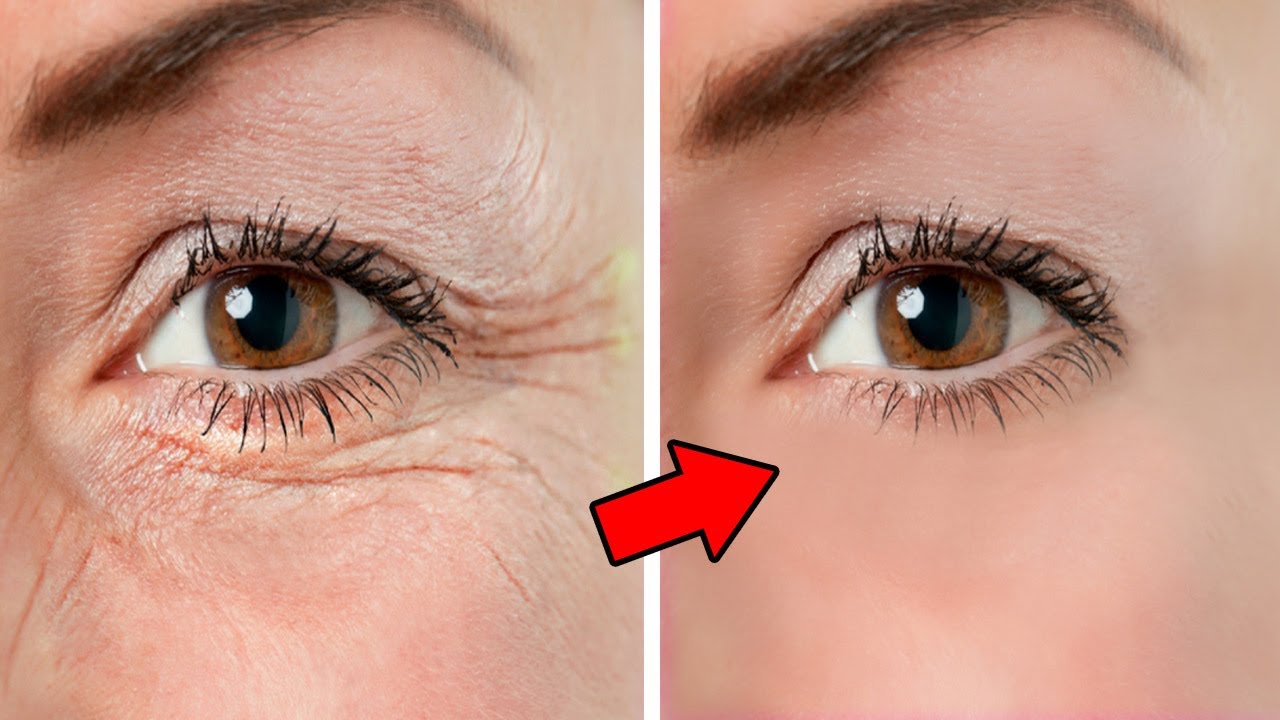 How to Remove Under Eye WRINKLES, Under Eye Bags, Puffy eyes & Dark