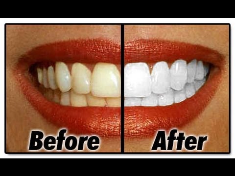 BLANQUEA tus dientes en MINUTOS! (remedio casero) - YouTube