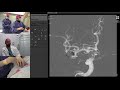 Transradial Coil Embolization of Unruptured Intracranial MCA Bifurcation Aneurysm