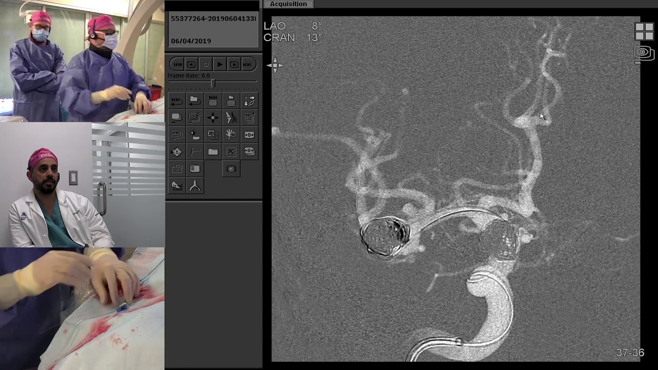 Transradial Coil Embolization of Unruptured Intracranial MCA Bifurcation Aneurysm YouTube