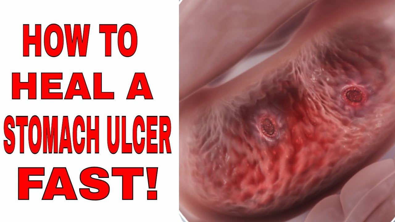 How to fix a ulcer