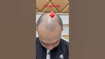 Bất ngờ chưa , tự nhiên hết hói #xămtóc #scalp #hói_đầu  một ngày xăm tóc tại tp hồ chí minh