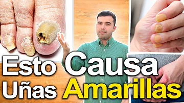 ¿Cuáles son las causas de las uñas amarillas y gruesas?