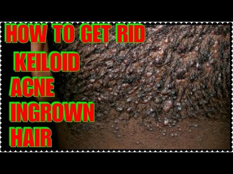 How To Get Rid Of Acne Ingrown Hair..At The Back Of Head