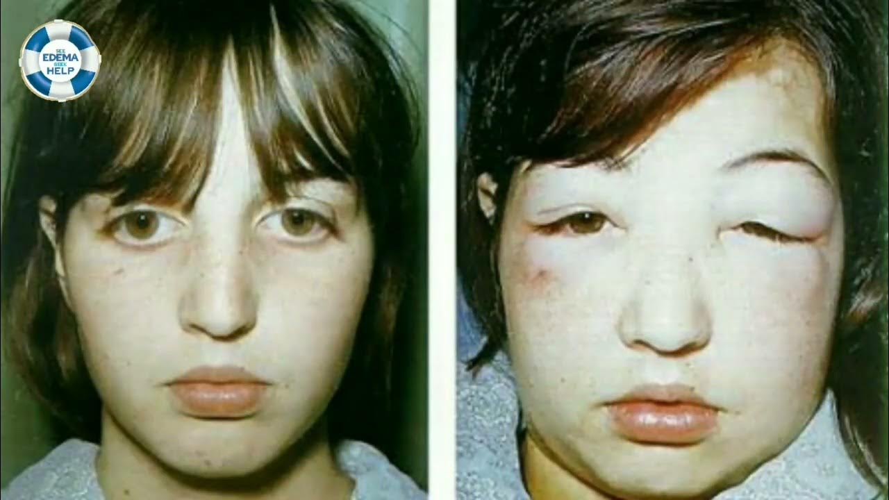 Know About Pedal Edema Causes, Symptoms & Treatment By Nephrologist Dr