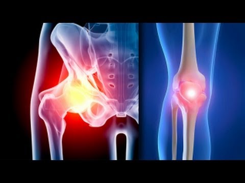 ce este tratamentul artrozei la genunchi