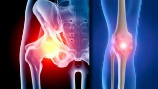 tipuri și tratamentul artrozei durere înjunghiată în articulațiile picioarelor