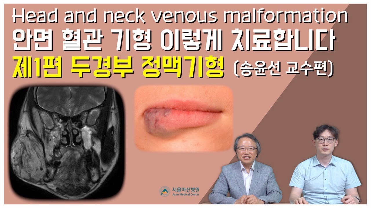 [두경부 혈관기형] 제1편 두경부 정맥기형 (안면 정맥기형) 이렇게 진단하고 치료 합니다 (영상의학과 송윤선 교수편)