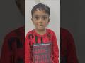 6 Years Follow Up after Bilateral Complete Cleft Lip Repair by Dr Pari Ladani