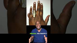 What Is Polydactyly?
