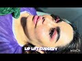 Lip Lift Before and After | Real Patient Transformation