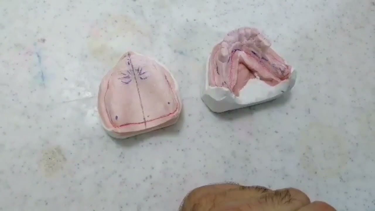 المرحلة (1) التأصيل العلمي عمل الطابع الإفرادي  custom tray أ.عمار جهماني