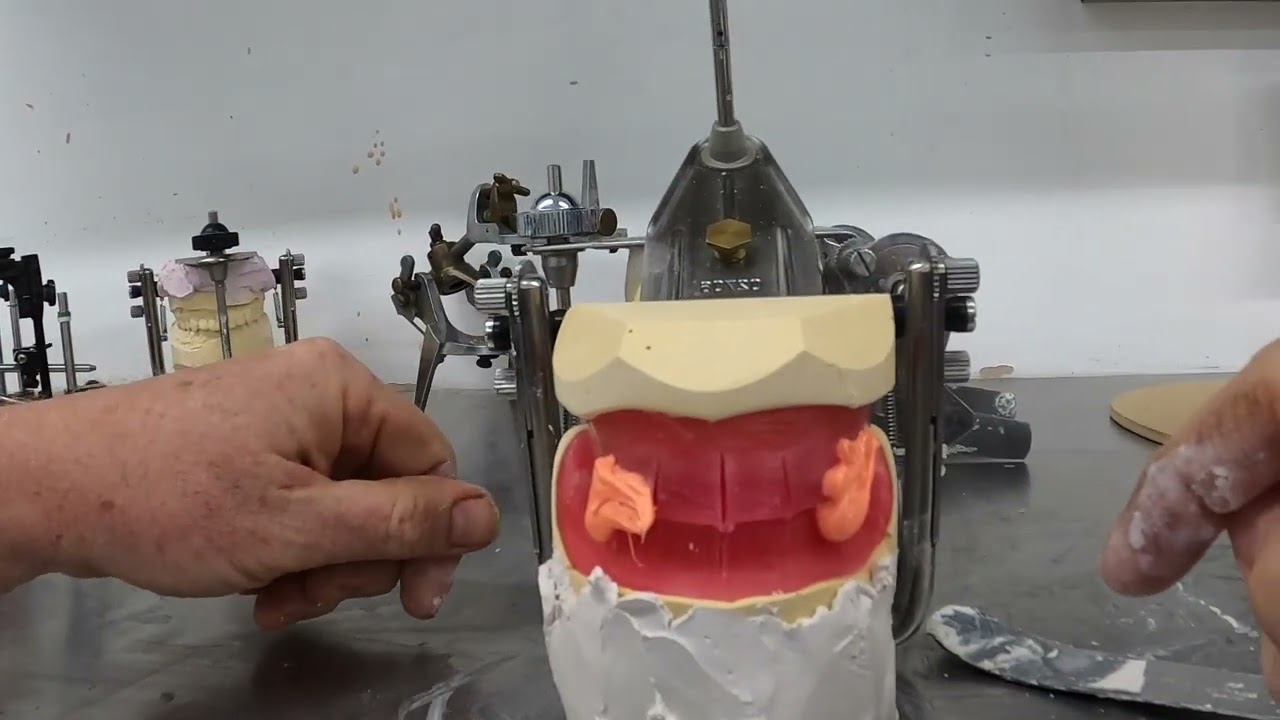 Complete Denture Course: Articulating Models after Occlusal