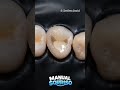 Como é feita uma Restauração Dentária!!