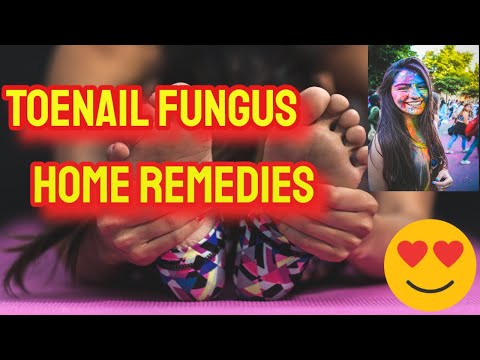 Toenail fungus home remedies | Holistic Natural Cures