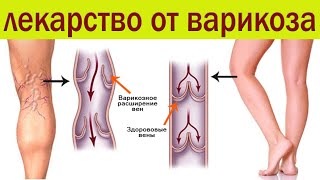 Aescusan is a medicine for varicose veins, leg swelling, hemorrhoids, and trophic ulcers. screenshot 4