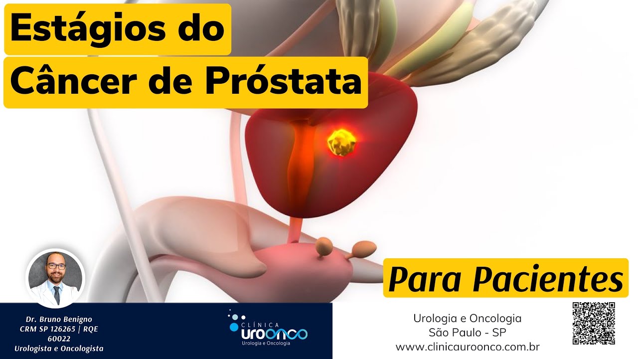Qual É O Estágio Avançado Do Câncer De Próstata?