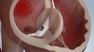 Pivot Bridge for TR (Tricuspid Regurgitation) by Tau-Medical