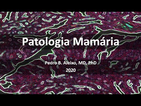 Vídeo: Infiltração Mamária - Sinais, Diagnóstico E Tratamento Da Infiltração Mamária