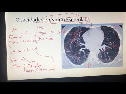 Video: ¿Qué es una opacidad pulmonar?