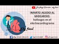 INFARTO AGUDO DE MIOCARDIO: Hallazgos electrocardiográficos.