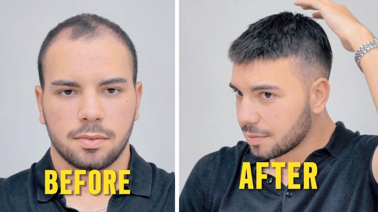 KISA PROTEZ SAÇ MODELİ - HAIR REPLACEMENT