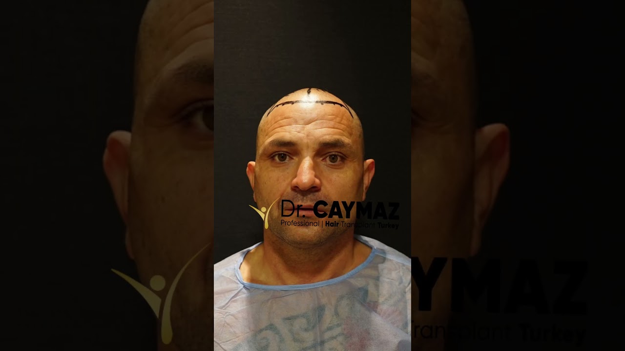 5250 Graft | 18 Months Result