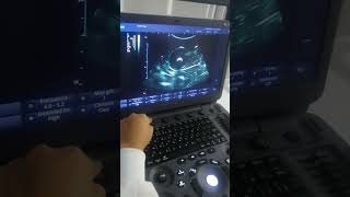Conociendo el Sonoscape E3 pro.