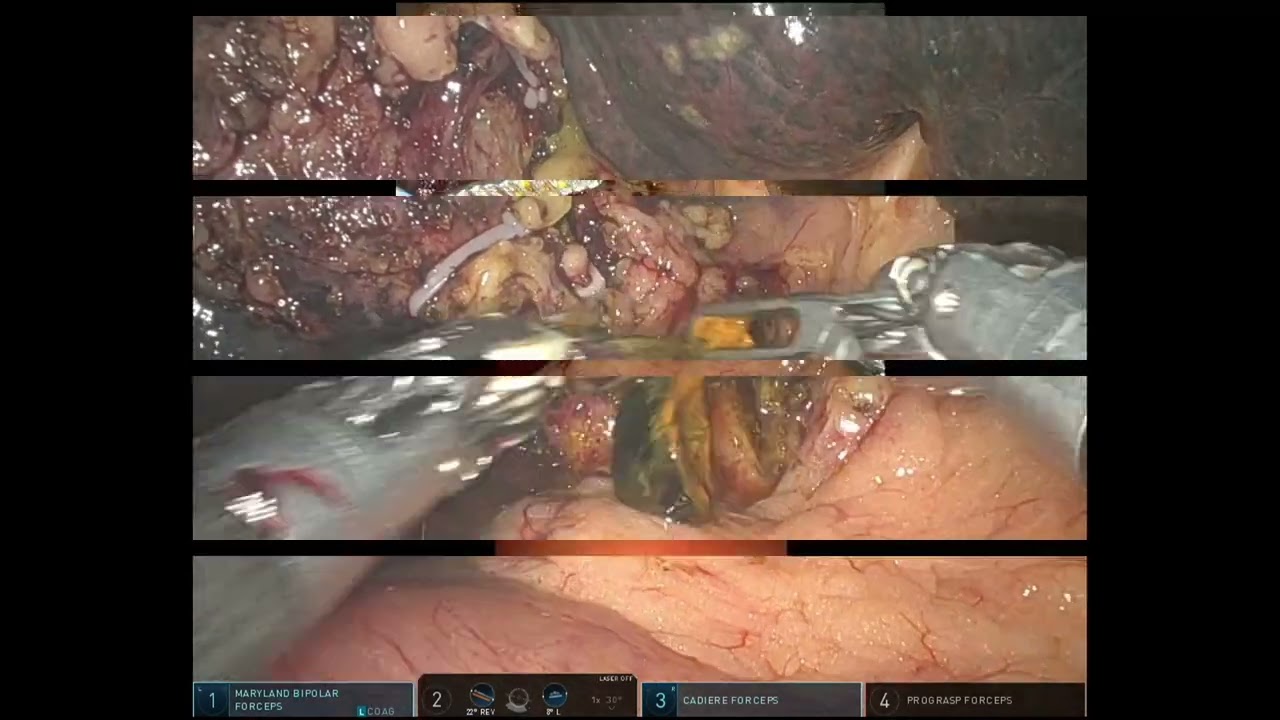 Robotic CBD exploration
