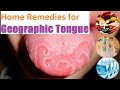 40+ What Helps Heal Geographic Tongue