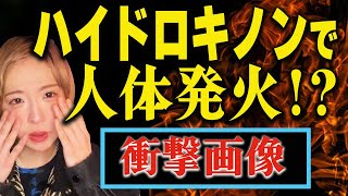 【衝撃画像】ハイドロキノンの使い方を間違えて一生後悔した話