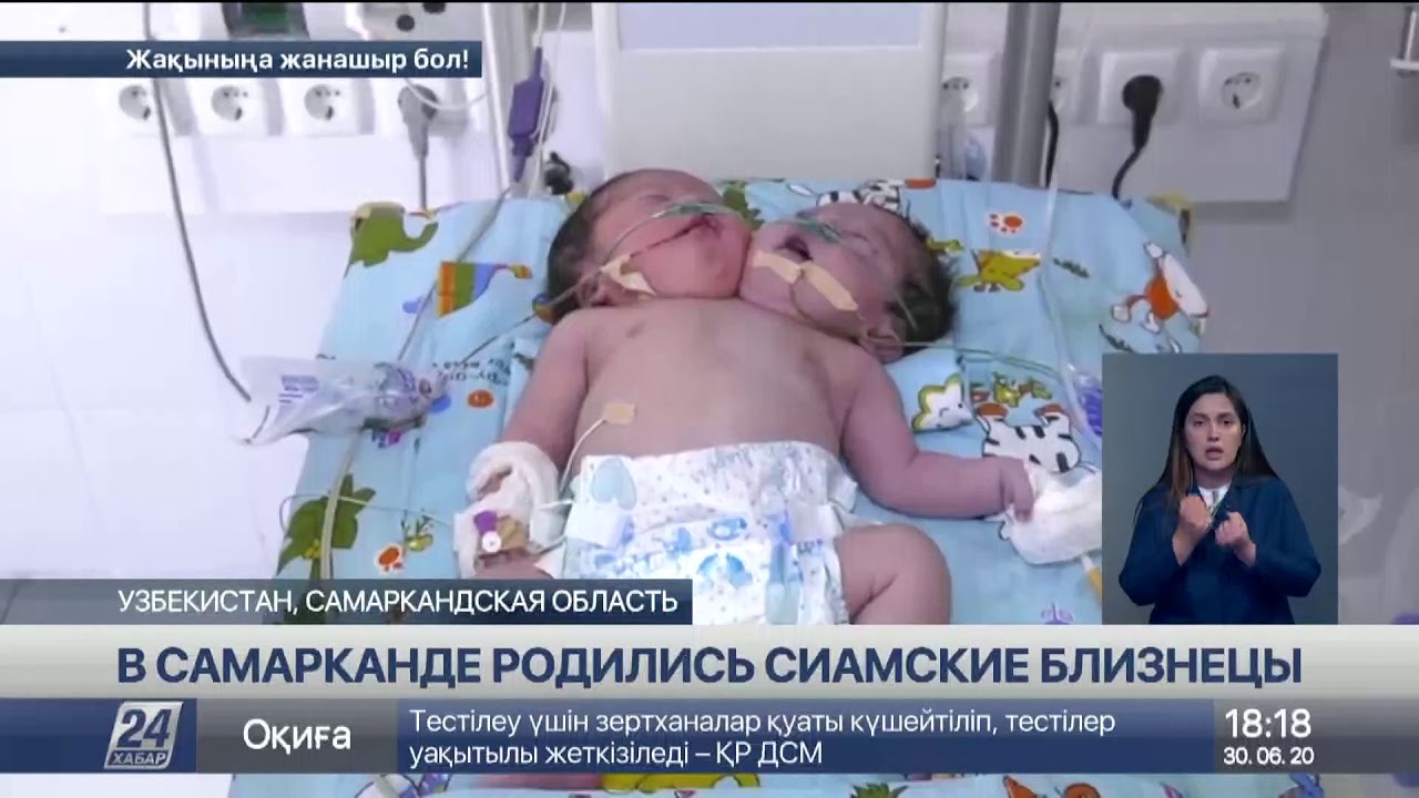 Двухголовые сиамские близнецы родились в Самарканде