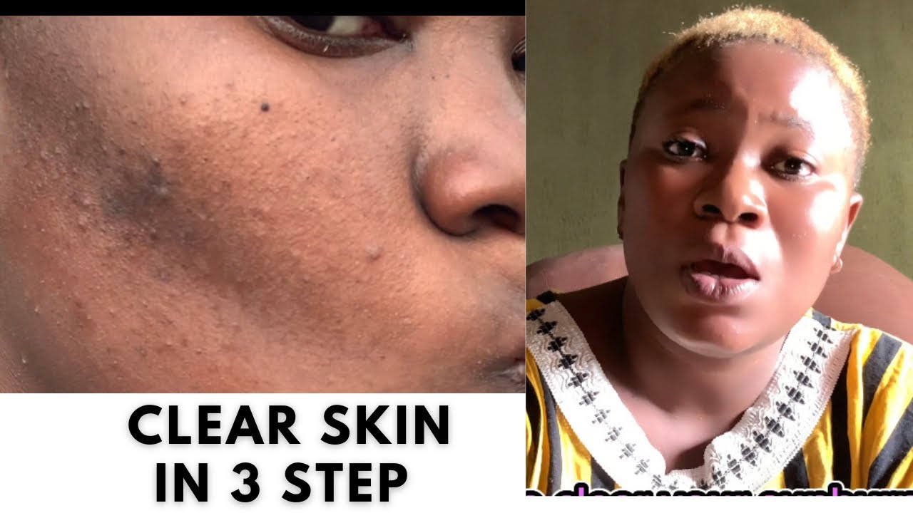 Acne journey part 2: how I cleared my skin / unsponsored skincare for ...