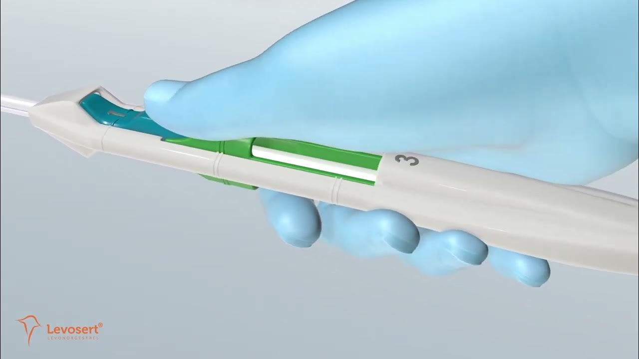 Levosert DIU YouTube